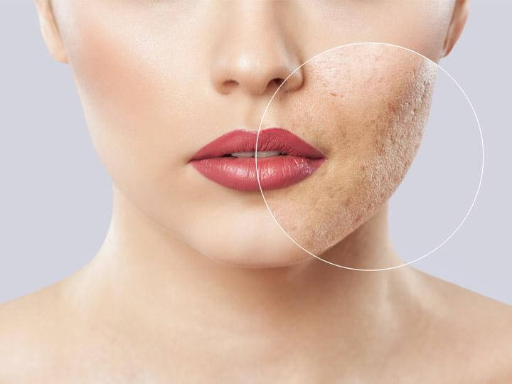 Skin Blemishes: Can there be spots on the skin from stress?