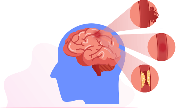 Vascular Dementia: Symptoms, Causes and Treatments