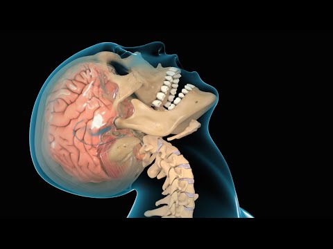 Cranioencephalic Trauma (TBI): Symptoms, Causes, Treatments