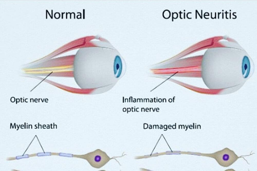 Optic Neuritis Symptoms Causes And Treatments